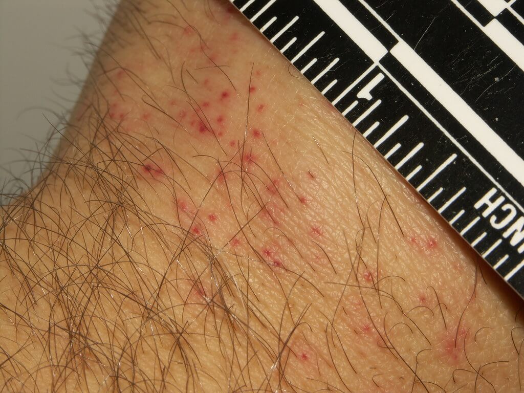 what bed bug bites look like